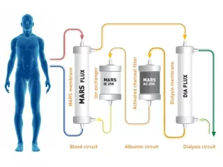 Illustration of extracorporeal toxin removal