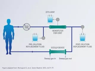Prismalung+ example of ECCO2R and CRRT setup